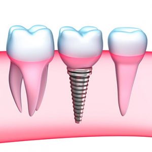 southside dental services dental implants background image