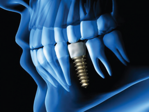 Dental Implants Services Our Services Southside Dental Winnipeg Dentist