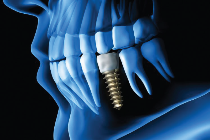 Dental Implants Services Our Services Southside Dental Winnipeg Dentist